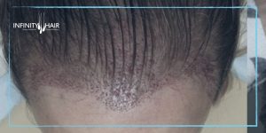 زراعة الشعر للنساء في تركيا