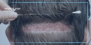 زراعة الشعر بدون حلاقة باستخدام تقنية DHI