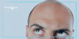 أحدث طرق زراعة الشعر في تركيا