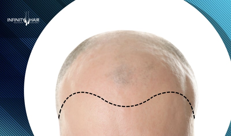 رسم خط الشعر اثناء عملية زراعة الشعر