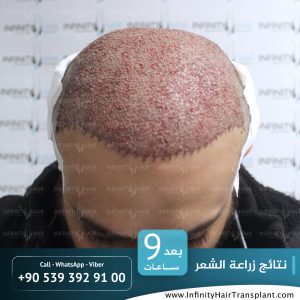 صور قبل وبعد عملية زراعة الشعر