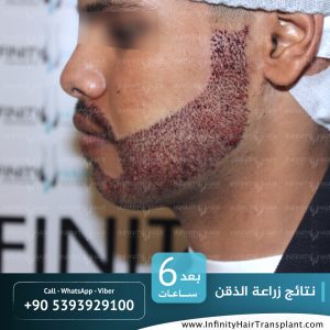 صور قبل وبعد عملية زراعة الشعر