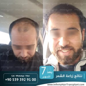 صور قبل وبعد عملية زراعة الشعر في تركيا لدى مركز إنفينيتي هير