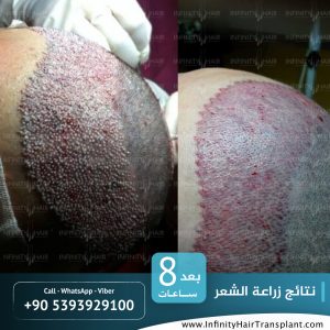 صور قبل وبعد عملية زراعة الشعر