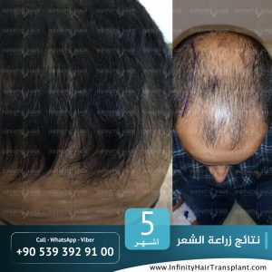 صور قبل وبعد عملية زراعة الشعر في تركيا لدى مركز إنفينيتي هير