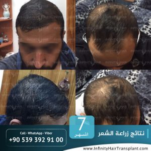 صور قبل وبعد عملية زراعة الشعر في تركيا لدى مركز إنفينيتي هير