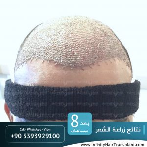 صور قبل وبعد عملية زراعة الشعر