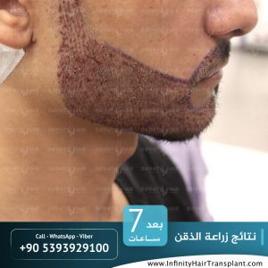 صور قبل وبعد عملية زراعة الشعر