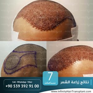 صور قبل وبعد عملية زراعة الشعر