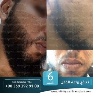 صور قبل وبعد عملية زراعة الشعر في تركيا لدى مركز إنفينيتي هير