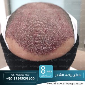 صور قبل وبعد عملية زراعة الشعر