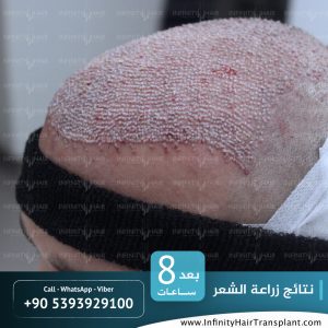 صور قبل وبعد عملية زراعة الشعر