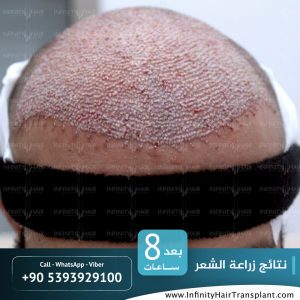 صور قبل وبعد عملية زراعة الشعر