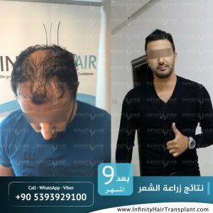 صور قبل وبعد عملية زراعة الشعر في تركيا لدى مركز إنفينيتي هير