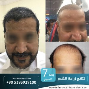 صور قبل وبعد عملية زراعة الشعر في تركيا لدى مركز إنفينيتي هير