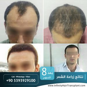 صور قبل وبعد عملية زراعة الشعر في تركيا لدى مركز إنفينيتي هير