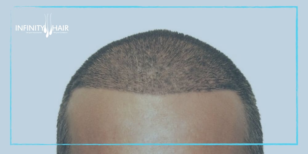 علاج الحكة بعد زراعة الشعر
