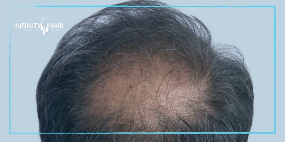 زراعة الشعر في اسطنبول - كيفية اختيار أفضل مركز زراعة شعر في إسطنبول؟