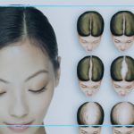 علاج تساقط الشعر للنساء في تركيا