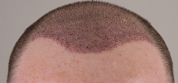 بخاخ minoxidil