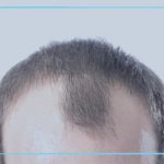المينوكسيديل لعلاج تساقط الشعر