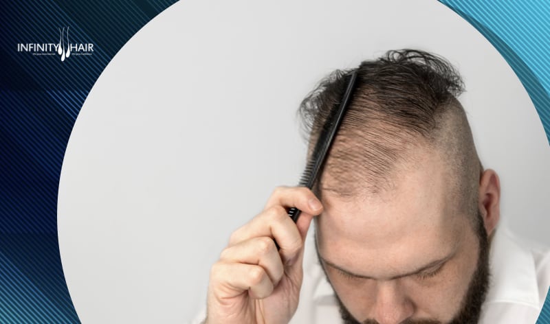 هل زراعة الشعر ناجحة وما هي عوامل نجاح العملية