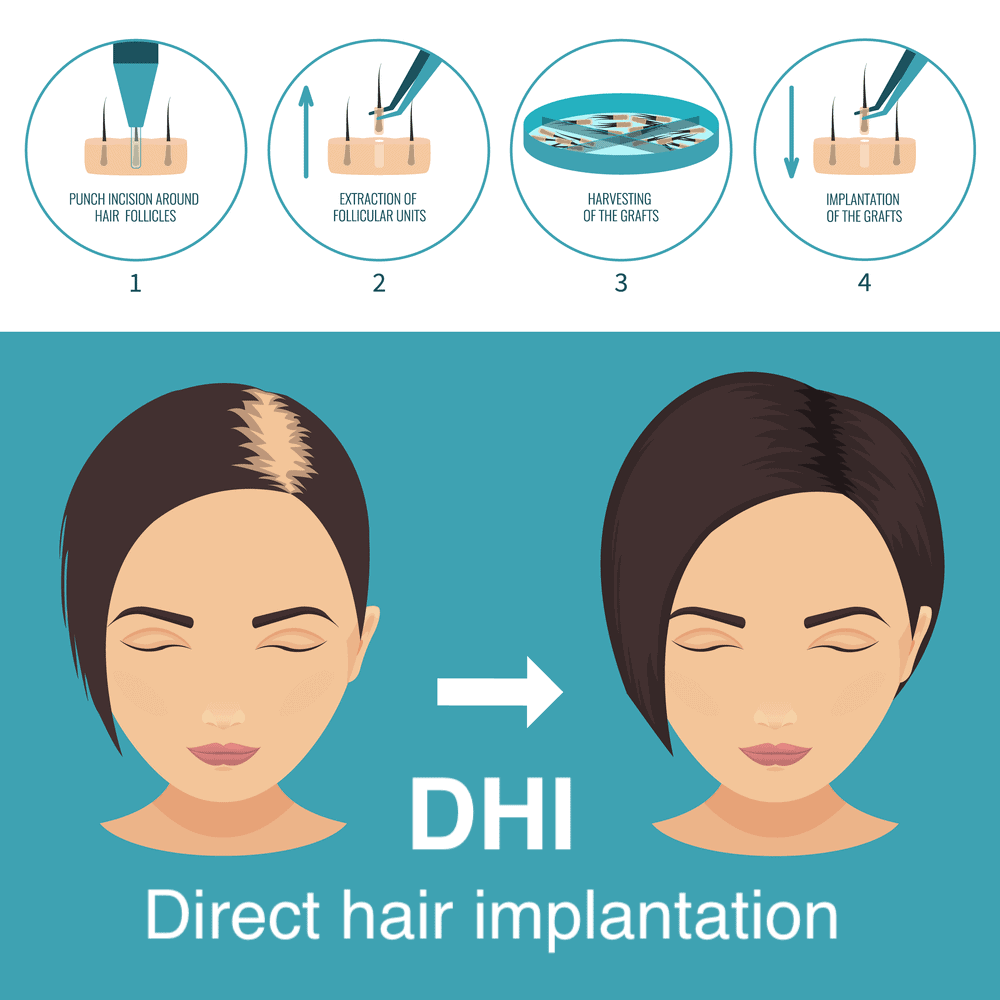 زراعة الشعر للنساء بدون حلاقة في تركيا