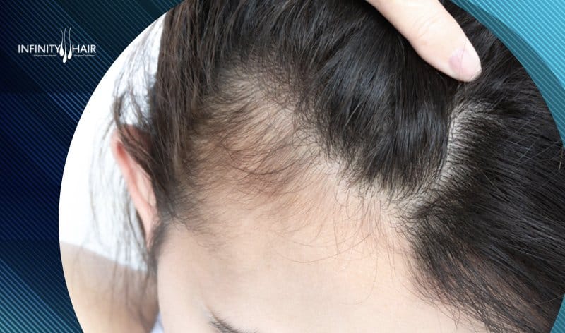 عمليات زراعة الشعر للنساء في تركيا