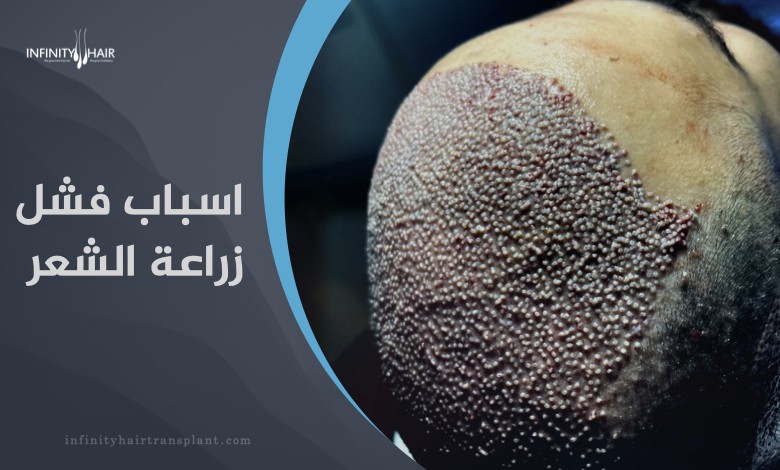 اسباب فشل زراعة الشعر