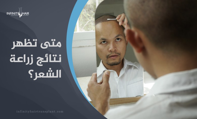 متى تظهر نتائج زراعة الشعر