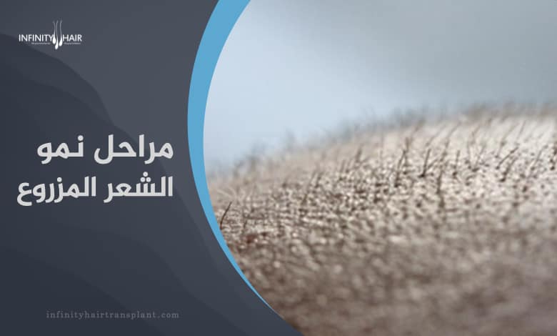 مراحل نمو الشعر المزروع بعد زراعة الشعر