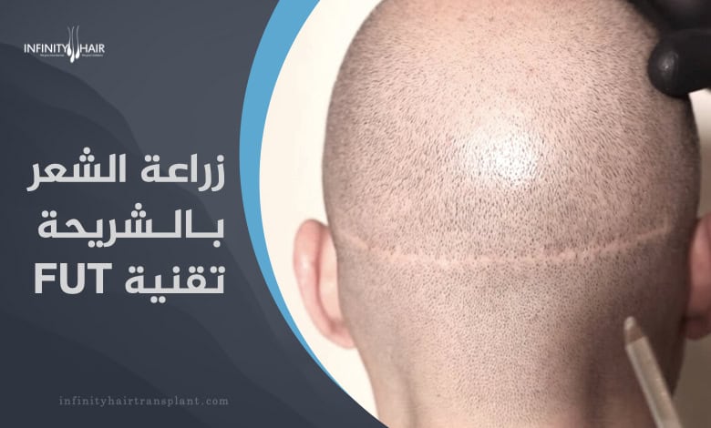 زراعة الشعر بالشريحة FUT