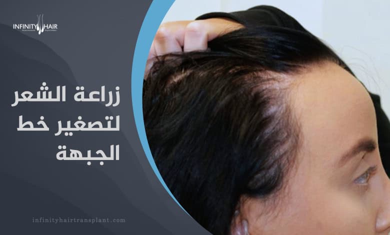 زراعة الشعر لتصغير الجبهة