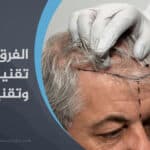 الفرق بين تقنية FUE وتقنية DHI في زراعة الشعر