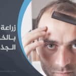 زراعة الشعر بالخلايا الجذعية