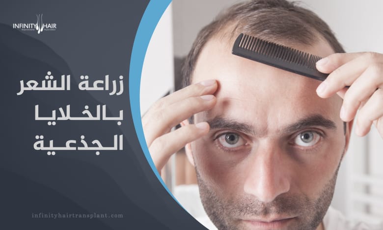 زراعة الشعر بالخلايا الجذعية