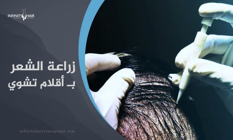 زراعة الشعر بتقنية أقلام تشوي