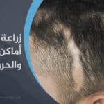 زراعة الشعر في أماكن الجروح والحروق