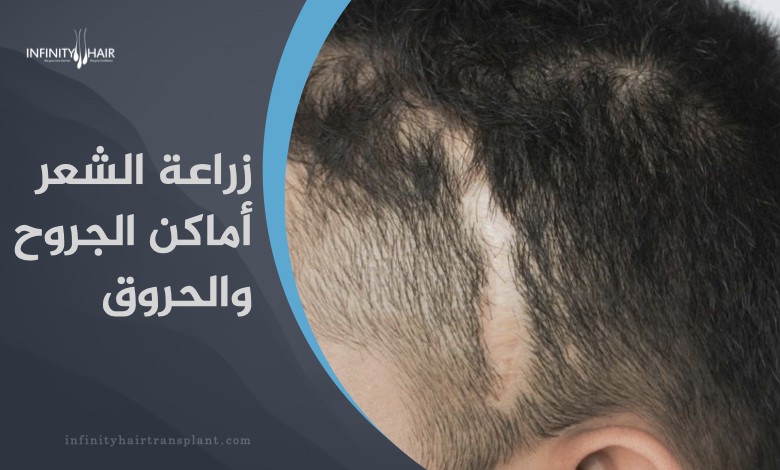 زراعة الشعر في أماكن الجروح والحروق