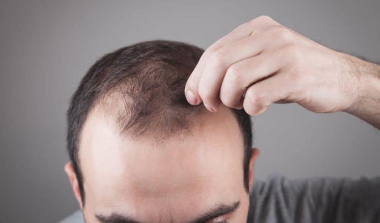 هل عملية زراعة الشعر مؤلمة