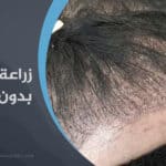 زراعة الشعر بدون حلاقة للرجال والنساء في تركيا