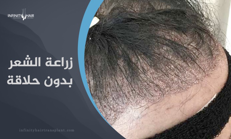 زراعة الشعر بدون حلاقة للرجال والنساء في تركيا