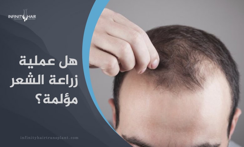 هل عملية زراعة الشعر مؤلمة، وهل يمكن زراعة الشعر بدون ألم