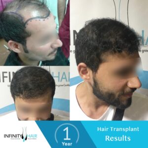 زراعة الشعر قبل وبعد