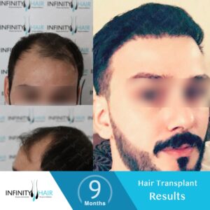 زراعة الشعر قبل وبعد