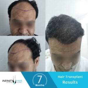 زراعة الشعر قبل وبعد